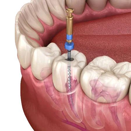 130664841-proceso-de-tratamiento-del-conducto-radicular-endodóntico-ilustración-3d-de-diente-médicamente-exact_preview_rev_1
