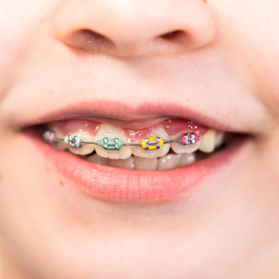 Close-up of the mouth of a girl with rainbow braces.