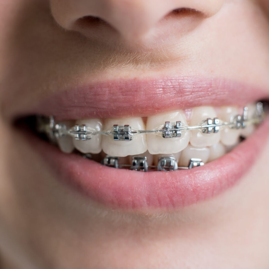 Close-up shot of teeth with braces. Smiling female patient with metal brackets at the dental office. Orthodontic Treatment