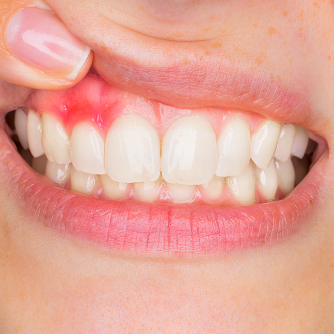 gingivitis