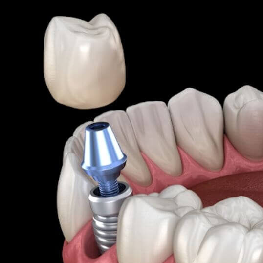 implante dental alta calidad