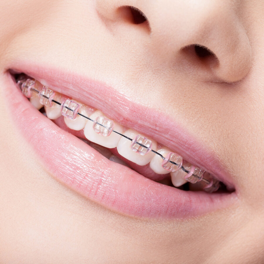 smiling-mouth-close-up-with-braces-2026-04-13-02-04-45-utc